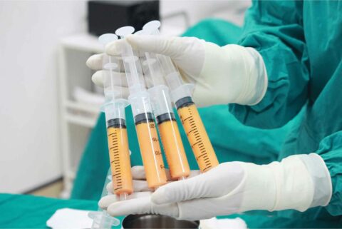 A surgeon holding four fat graft syringes.